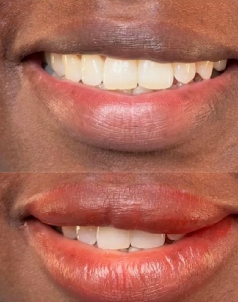 Dark Lip Neutralization before and after, Frenkel PMU House