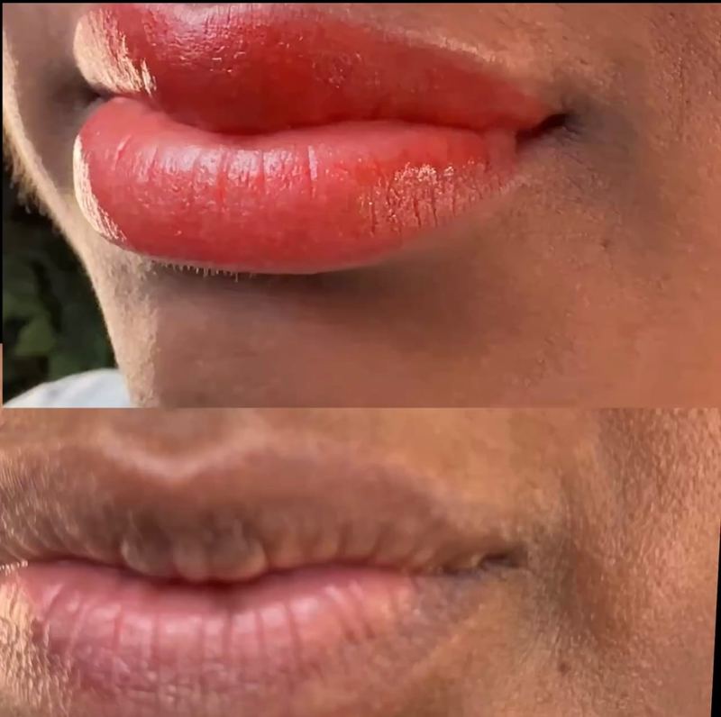Lip Liner Enhancement before and after, Frenkel PMU House