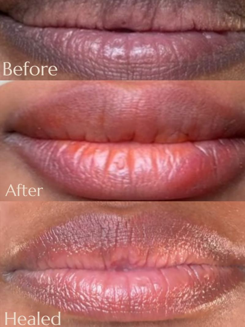 Dark Lip Neutralization before and after, Frenkel PMU House
