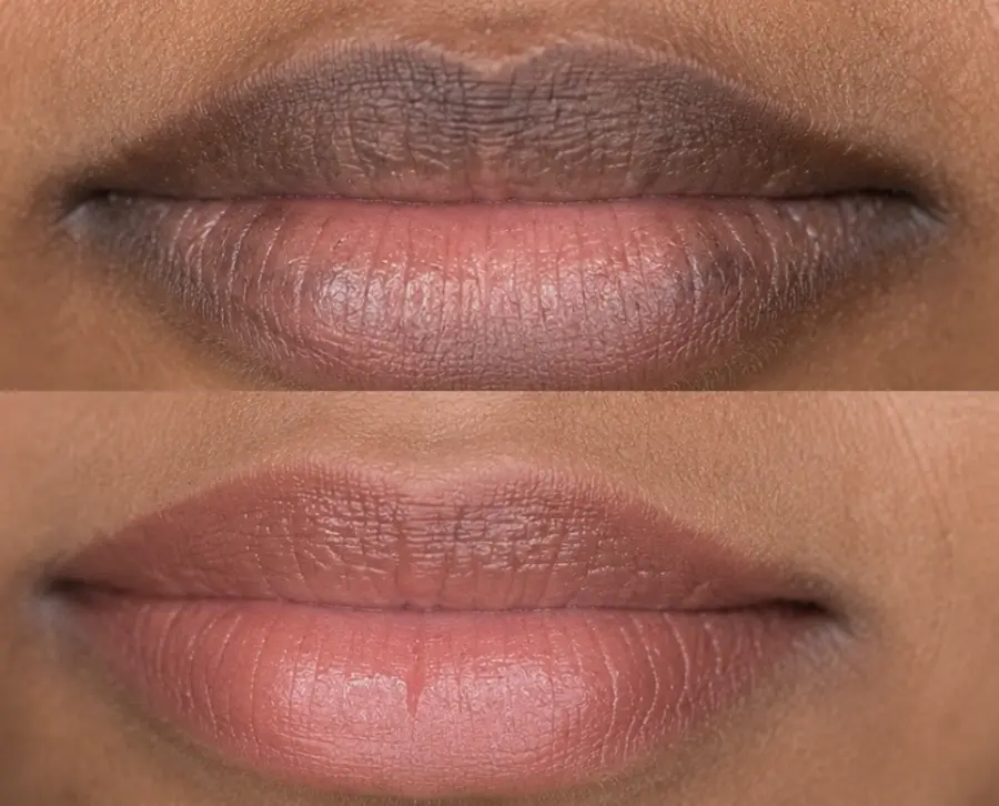 Dark lip neutralization before and after result